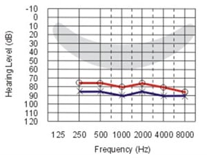 آشنایی با درجات مختلف افت شنوایی