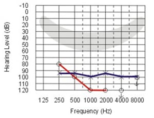 آشنایی با درجات مختلف افت شنوایی