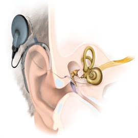 تفاوت کاشت حلزون و سمعک