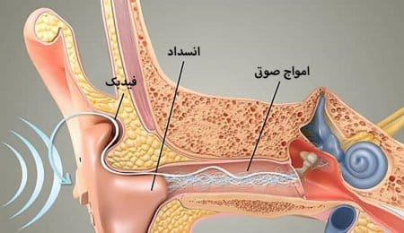 دلیل سوت کشیدن سمعک چیست؟