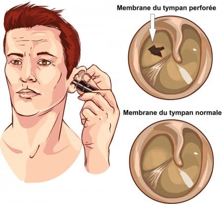 پارگی پرده ی گوش